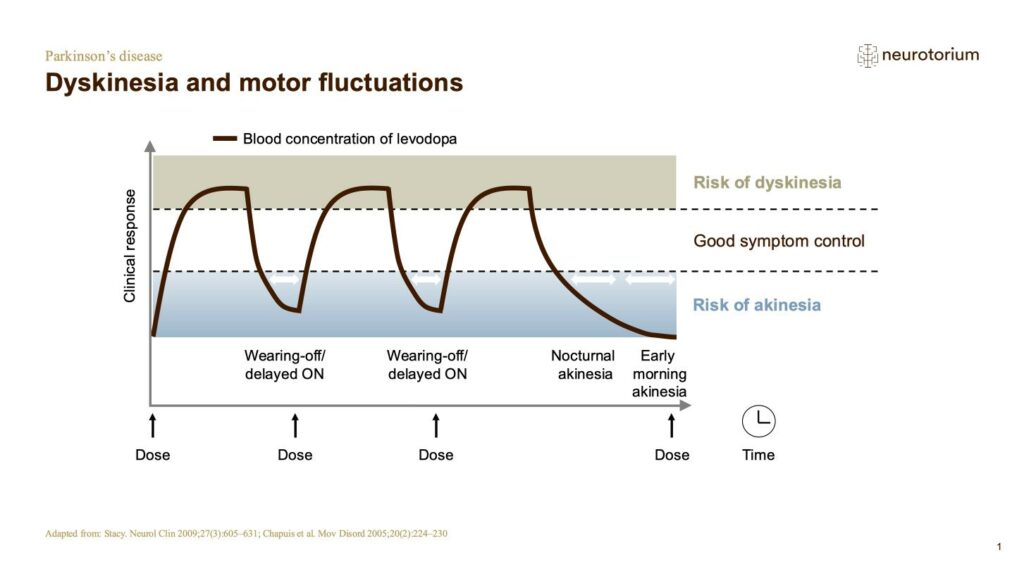 Dyskinesia and motor fluctuations